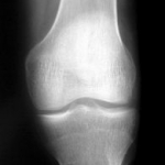 New Arthritis Guidelines